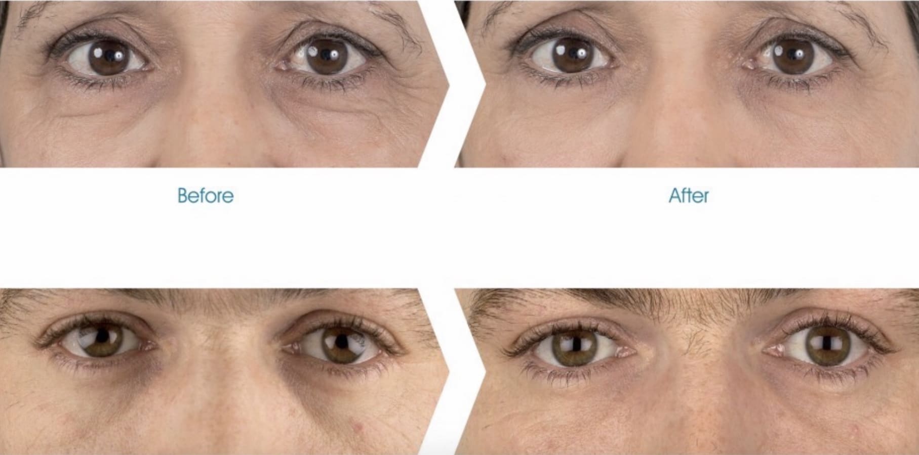 Cernes - Médecine Esthétique du visage - Dr Arbab